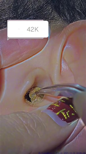 #ear #wax #earwax #earwaxremoval #earwaxremover (15)