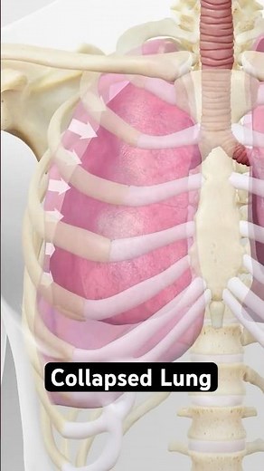 Collapsed lung explained (3D Animation)