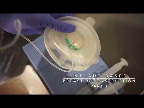 Breast Reconstruction After Mastectomy with Tissue Expanders - Dr. Amaka explains the process