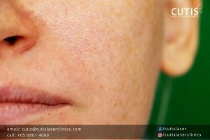 Difference Between Hyperpigmentation and Hypopigmentation