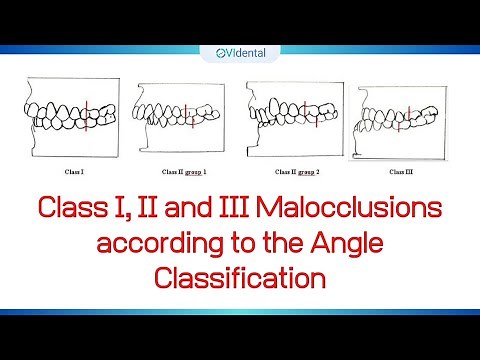Class I, II and III Malocclusions according to the Angle Classification