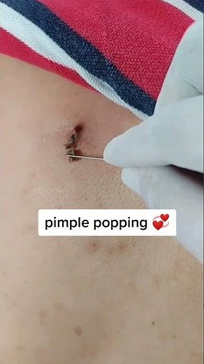 Blackheads 2021 newest dr pimple popping videos Ep 98