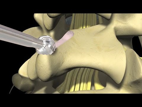 Low Back Pain: Lumbar Laminectomy Surgery