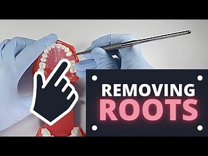 How To Extract Roots Covered By Soft Tissue | OnlineExodontia.com