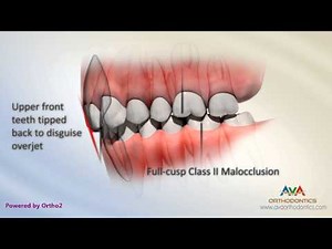 Malocclusion - Class II Div 2