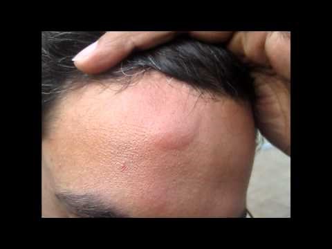 Head Injury Bump- Home Treatment