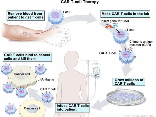 T-cell Transfer Therapy - Immunotherapy