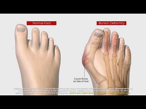 What Is Lapiplasty® 3D Bunion Correction®? | All About The Lapiplasty® Procedure