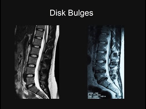 Back Pain - Part 1: Why MRI Scans Are Important.