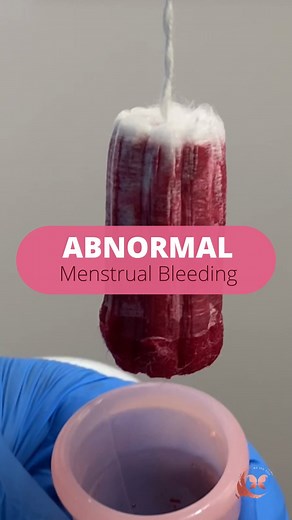 13K views · 33 reactions | Abnormal menstrual bleeding refers to any...
