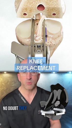 ACL “Saving” Knee Replacement 🦿Primary total knee arthroplasty (TKA) is a widespread surgery, capable of recovering articular function and relieving pain in end-stage osteoarthritis of the knee. Once considered a procedure for the elderly,TKA is now being performed frequently in younger and high-demanding patients. Specifically, in the next years, side by side with an overall consistent increase for this procedure demand, the amount of TKA implanted before 65-years-old will exceed 55% of the to