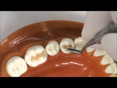 小臼歯コンポジットレジン充填デモ－トクヤマデンタル製品－