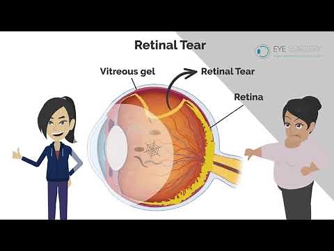 Retinal Detachment