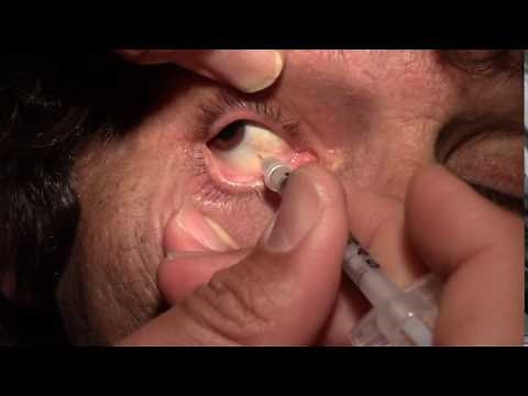 Right Intravitreal Lucentis Injection