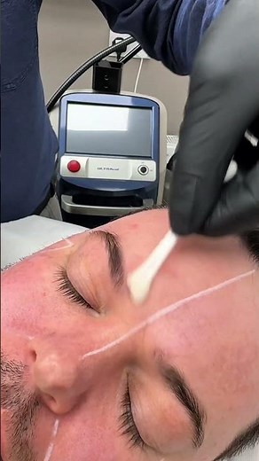 Transform Your Skin with TCA Chemical Peel: Results & Process Explained