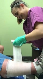 Unna boot wraps for venous ulcers | Vein Treatment Center | Facebook