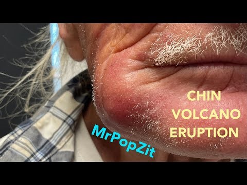 SO MUCH PRESSURE! Then POP. Inflamed cyst mounts huge inflammatory response on face. I+D procedure