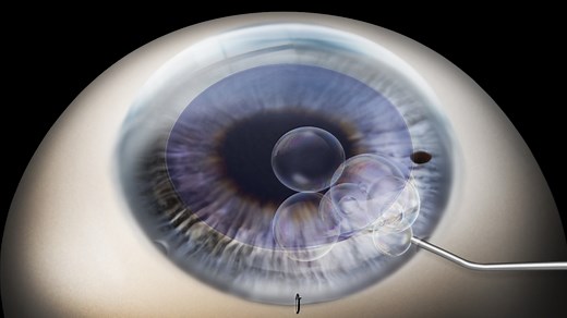 Descemet membrane endothelial keratoplasty (DMEK) animation
