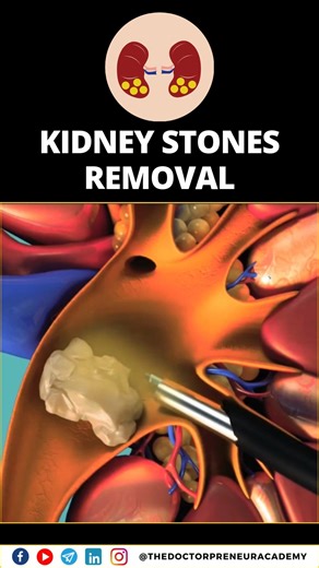 The Doctorpreneur Academy on Instagram: "🩺 Kidney Stones Removal Surgery – PCNL Explained! 📌 Percutaneous Nephrolithotomy (PCNL) is a minimally invasive surgery used to remove large or stubborn kidney stones that cannot pass naturally. 🔹 Procedure Steps: ✔️ A small incision is made in the back 🔪 ✔️ A tube & camera help locate the stone 📹 ✔️ The stone is broken & removed using special tools 🩻 ✔️ Faster recovery compared to open surgery 🚑 💡 Stay hydrated & maintain a healthy diet to preven
