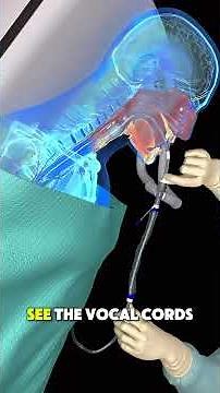 Endotracheal intubation 3d Animation