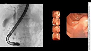 15 reactions | E-Video: EUS-guided rendezvous technique: 22 G needle...
