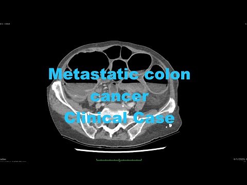 Clinical Case - metastatic colon cancer - CT - synchronous sigmoid carcinoma with liver mets