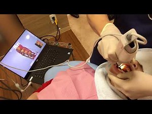 【口腔内スキャナー】TRIOS3(トリオス3)でデジタルインプレッションー3shape-SHOFUー