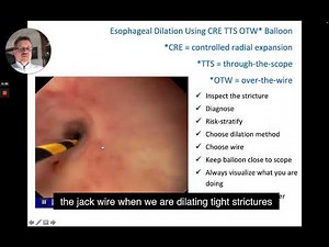 Esophageal Dilation Using a TTS, OTW, CRE (Through-the-Scope, Over-the-Wire