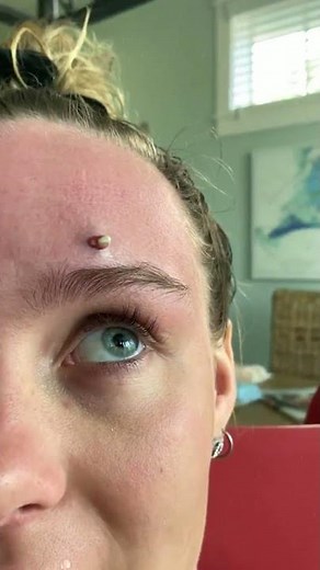 Blackheads 2021 newest dr pimple popping videos Ep 203