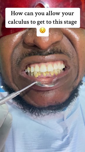 Scaling help remove stain ,calculus and also get rid of bad breath,send us a dm today #scalingteeth🦷 #scaling #teeth #top #fyp #goviral #explore #badbreath