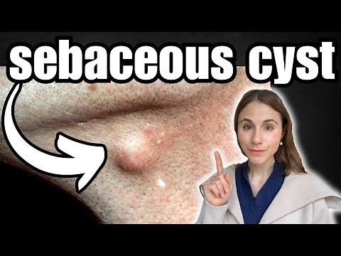 The Only Way To Remove A Sebaceous Cyst