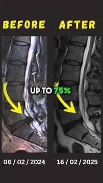 What's the natural healing rate of Lumbar Disc Extrusion
