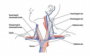 Symptoms and conditions of internal jugular vein compression and stenosis