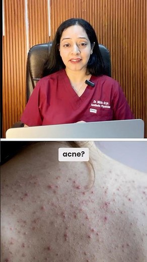 How to Get Rid of Back Acne | Doctor's Guide