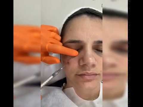 Preenchimento de Olheiras com cânula!