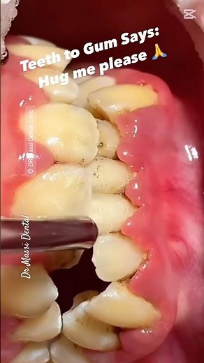 PERIODONTAL ISSUES, DEEP CLEANING
