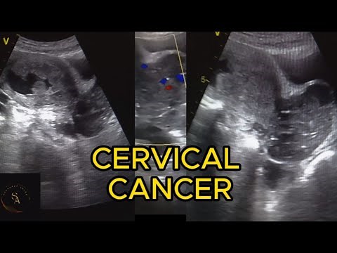 Cervical Cancer in ultrasound