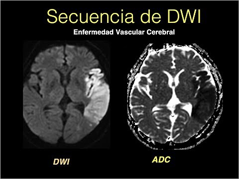 Secuencia de Difusión DWI cerebral //Parte 2//Principios básicos//Dr. Daniel Flores.