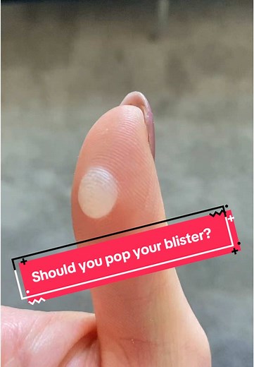 Understanding and Treating Blisters on Hands