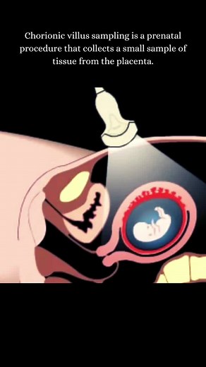 Understanding Chorionic Villus Sampling Procedure