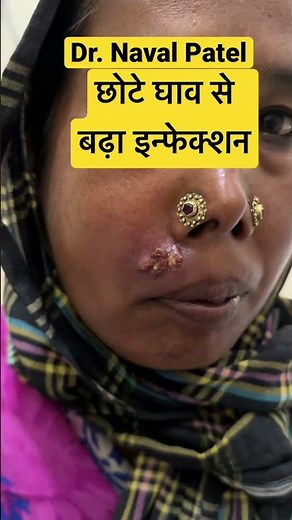 Unlock the Mystery of Furuncles: Why Do They Occur?