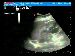 Ultrasound image of Polycystic Kidney Disease (ADPKD)