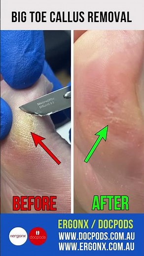 Ultimate Big Toe Callus Removal with Scalpel by Podiatrist #FootCare #CallusRemoval