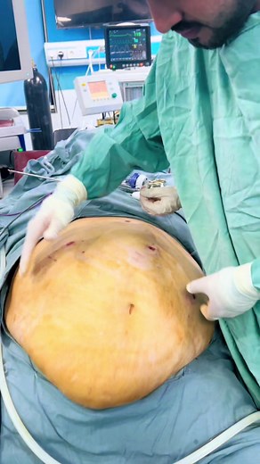 Understanding Super Morbid Obesity