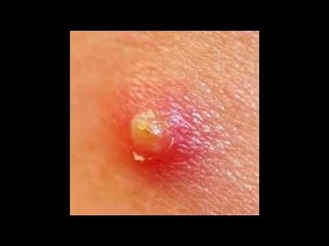 How To Treat And Cure Carbuncle