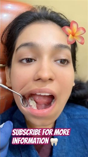 Capping of tooth#Dental #Dentist #oralhealth