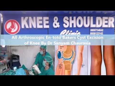 Arthroscopic Removal of Bakers Cyst- No Recurrence & Fastest Recovery