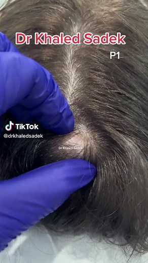 Effective Ways to Treat Pilar Cysts and Prevent Recurrence