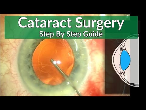 Cataract Surgery - A Beginners Guide