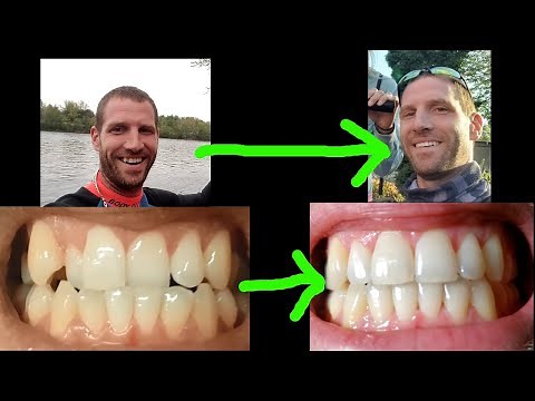 Before and After INVISALIGN - My Experience/Review (Dr. Klatte)